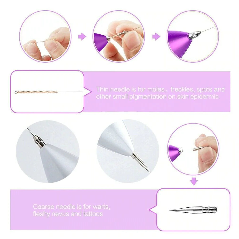 Electric Laser Plasma Pen Removes Moles