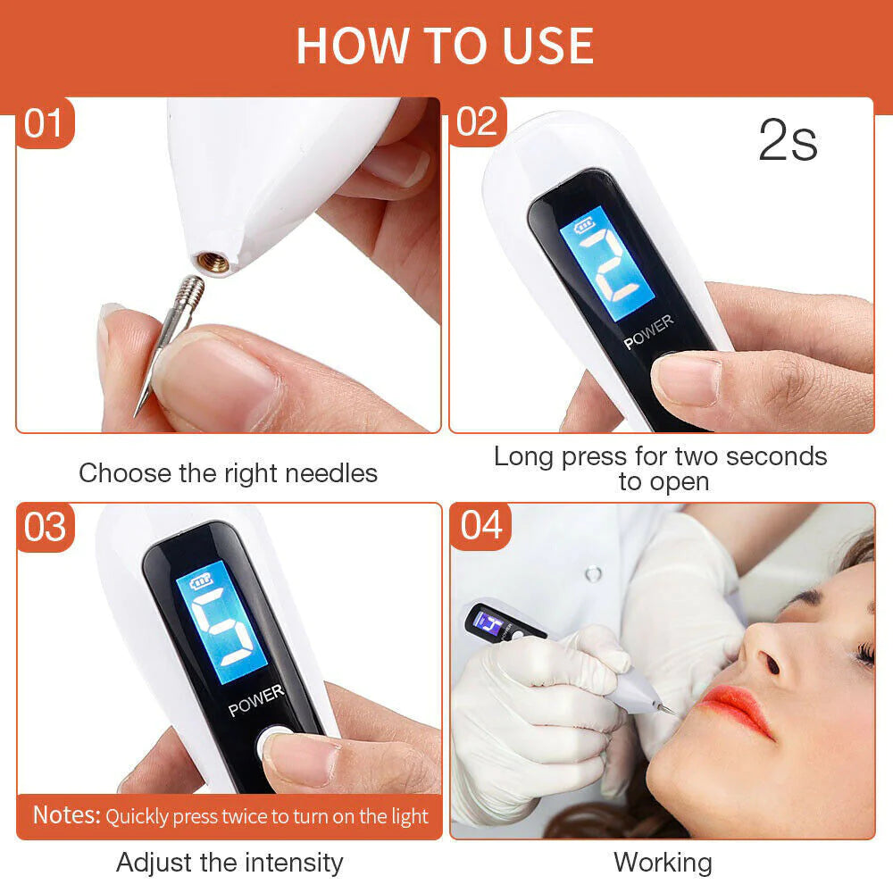 Electric Laser Plasma Pen Removes Moles