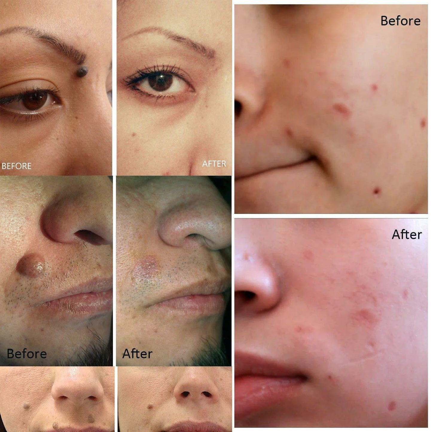 Electric Laser Plasma Pen Removes Moles