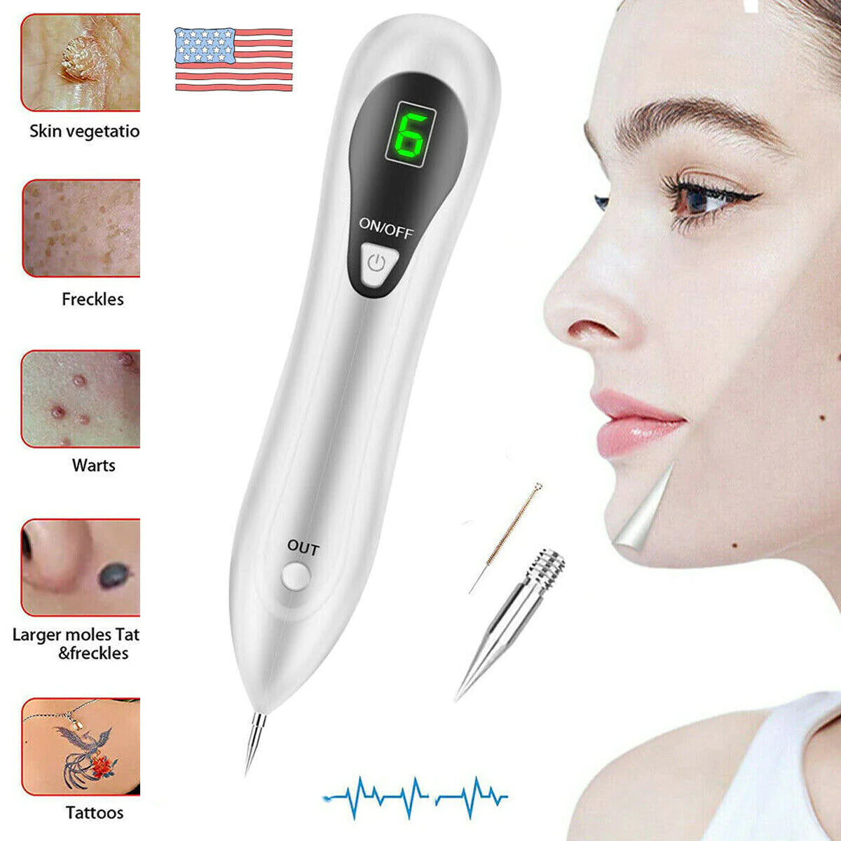 Electric Laser Plasma Pen Removes Moles